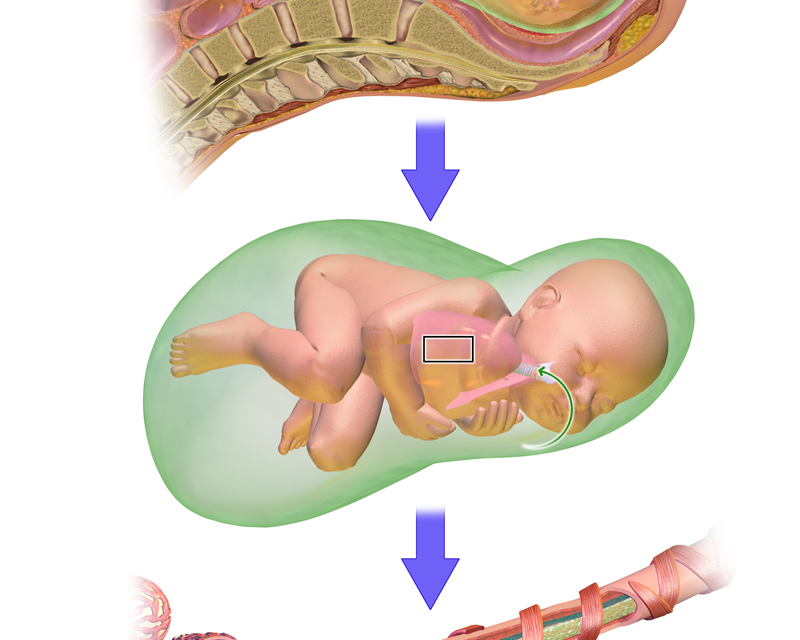 ‘Homebirth’ dan ‘Meconium Aspiration Syndrome’/Bayi Makan Najis